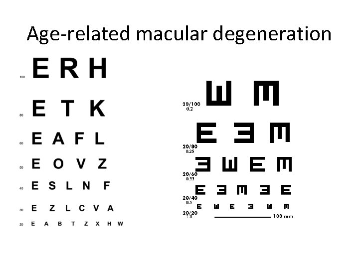 Age-related macular degeneration 