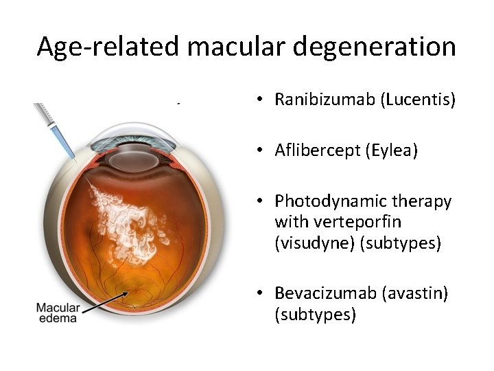 Age-related macular degeneration • Ranibizumab (Lucentis) • Aflibercept (Eylea) • Photodynamic therapy with verteporfin