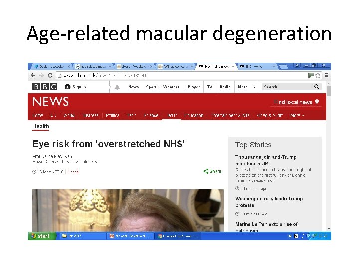 Age-related macular degeneration 