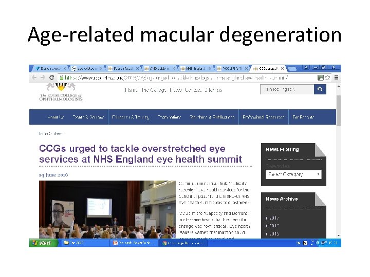 Age-related macular degeneration 