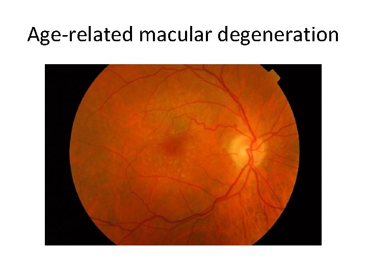 Age-related macular degeneration 