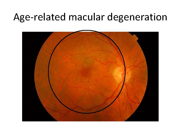 Age-related macular degeneration 