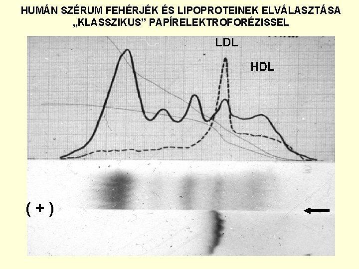 HUMÁN SZÉRUM FEHÉRJÉK ÉS LIPOPROTEINEK ELVÁLASZTÁSA „KLASSZIKUS” PAPÍRELEKTROFORÉZISSEL LDL HDL ( + ) 