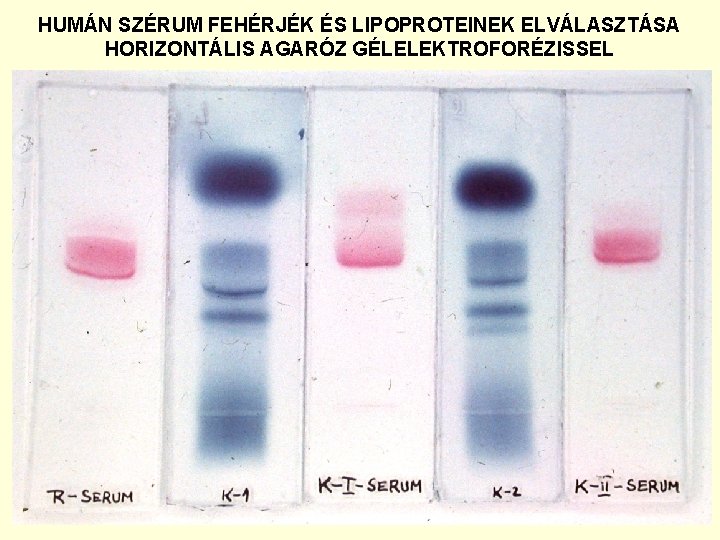 HUMÁN SZÉRUM FEHÉRJÉK ÉS LIPOPROTEINEK ELVÁLASZTÁSA HORIZONTÁLIS AGARÓZ GÉLELEKTROFORÉZISSEL 