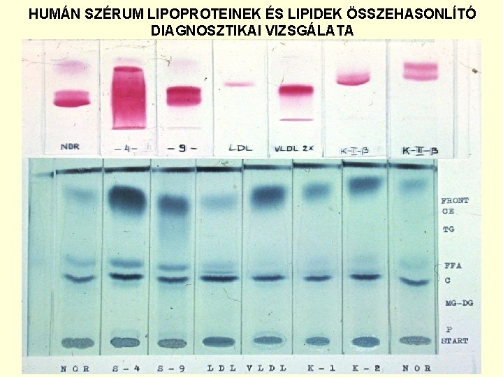 HUMÁN SZÉRUM LIPOPROTEINEK ÉS LIPIDEK ÖSSZEHASONLÍTÓ DIAGNOSZTIKAI VIZSGÁLATA 