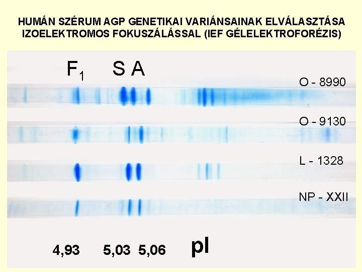 HUMÁN SZÉRUM AGP GENETIKAI VARIÁNSAINAK ELVÁLASZTÁSA IZOELEKTROMOS FOKUSZÁLÁSSAL (IEF GÉLELEKTROFORÉZIS) F 1 SA O