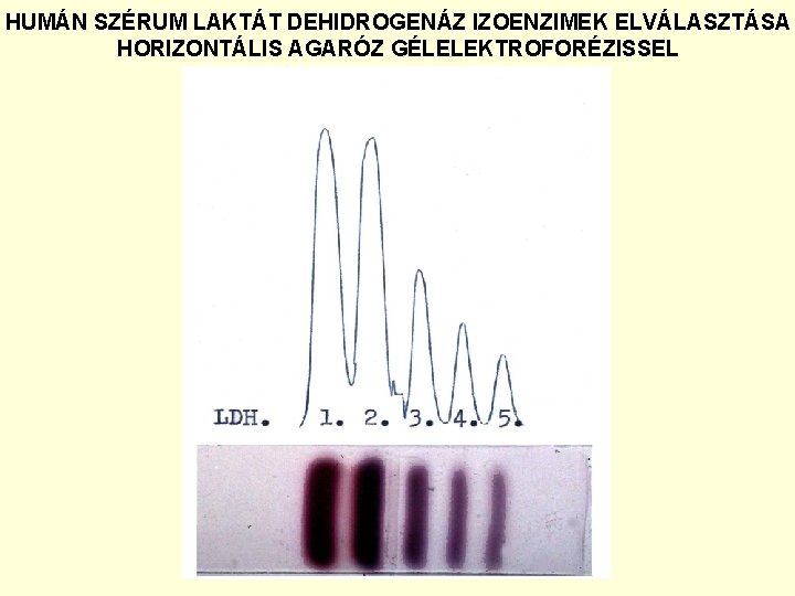 HUMÁN SZÉRUM LAKTÁT DEHIDROGENÁZ IZOENZIMEK ELVÁLASZTÁSA HORIZONTÁLIS AGARÓZ GÉLELEKTROFORÉZISSEL 