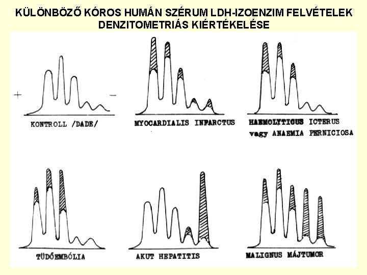 KÜLÖNBÖZŐ KÓROS HUMÁN SZÉRUM LDH-IZOENZIM FELVÉTELEK DENZITOMETRIÁS KIÉRTÉKELÉSE 