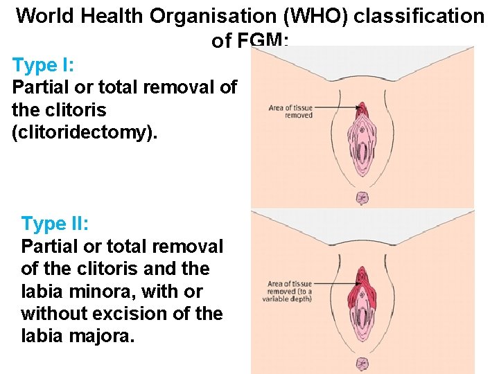 World Health Organisation (WHO) classification of FGM: Type I: Partial or total removal of