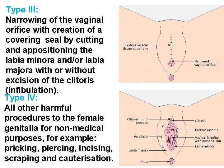 Type III: Narrowing of the vaginal orifice with creation of a covering seal by