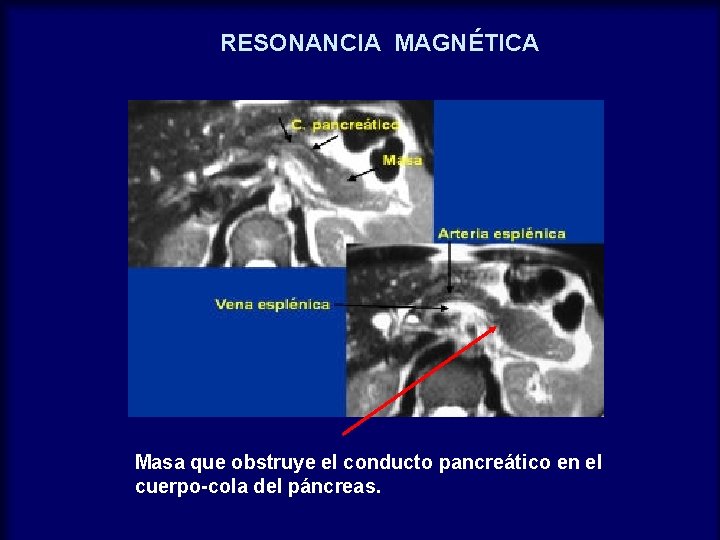 RESONANCIA MAGNÉTICA Masa que obstruye el conducto pancreático en el cuerpo-cola del páncreas. 