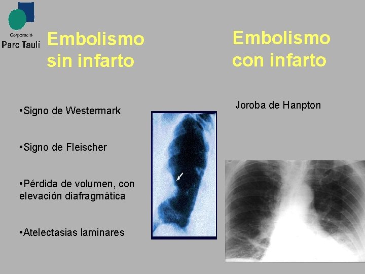 Embolismo sin infarto • Signo de Westermark • Signo de Fleischer • Pérdida de