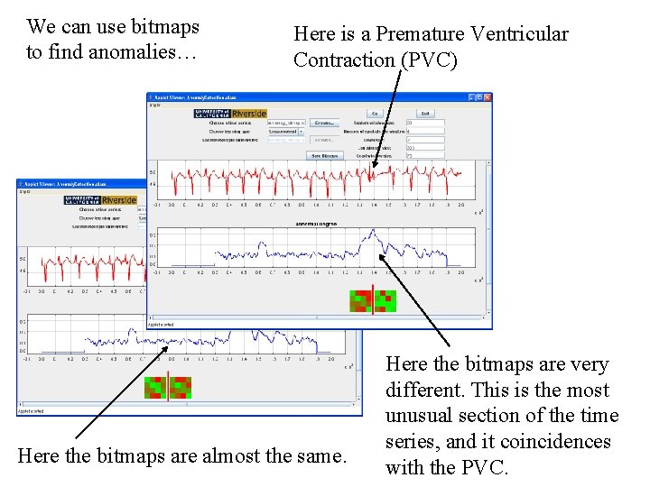 We can use bitmaps to find anomalies… Here is a Premature Ventricular Contraction (PVC)