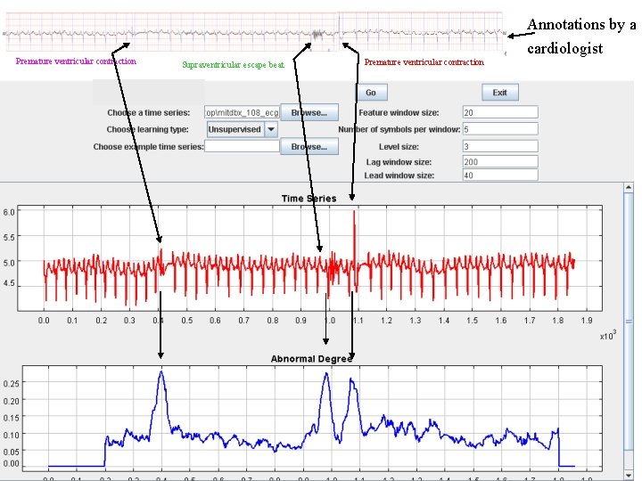 Annotations by a Premature ventricular contraction Supraventricular escape beat Premature ventricular contraction cardiologist 