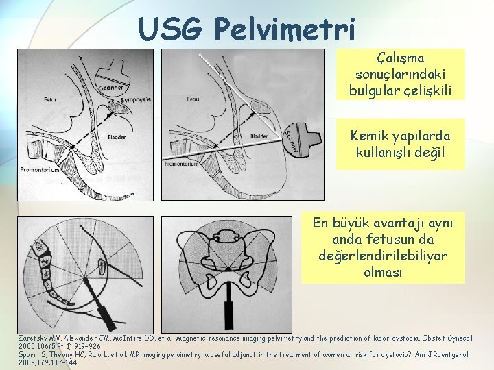 USG Pelvimetri Çalışma sonuçlarındaki bulgular çelişkili Kemik yapılarda kullanışlı değil En büyük avantajı aynı