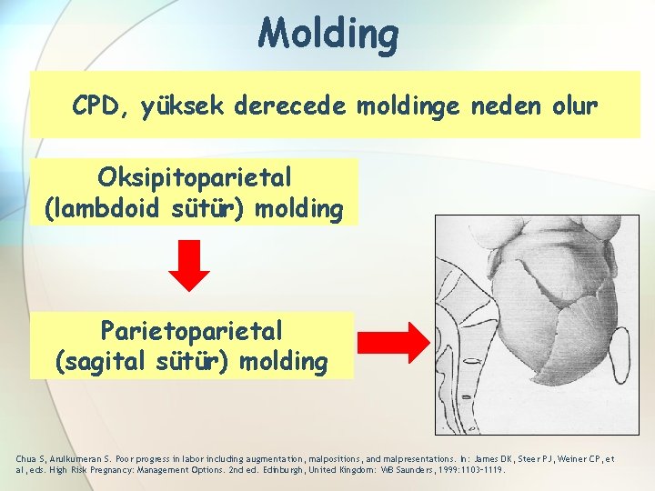 Molding CPD, yüksek derecede moldinge neden olur Oksipitoparietal (lambdoid sütür) molding Parietoparietal (sagital sütür)