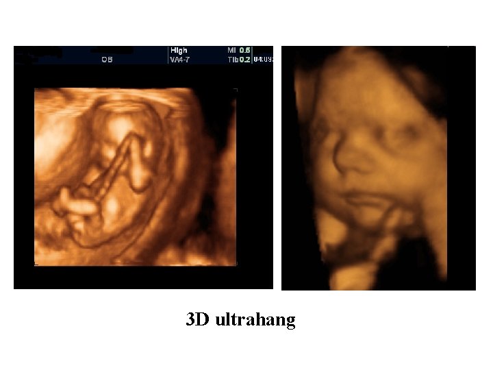 3 D ultrahang 