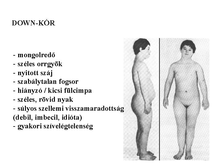 DOWN-KÓR - mongolredő - széles orrgyök - nyitott száj - szabálytalan fogsor - hiányzó