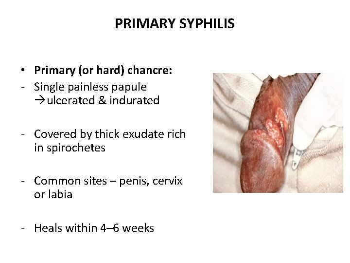 PRIMARY SYPHILIS NIFESTATIONS OF SYPHILIS • Primary (or hard) chancre: - Single painless papule