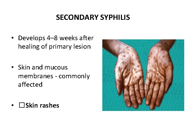 SECONDARY SYPHILIS • Develops 4– 8 weeks after healing of primary lesion • Skin