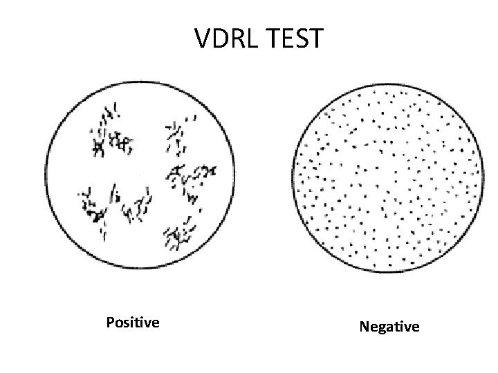 VDRL TEST Positive Negative 