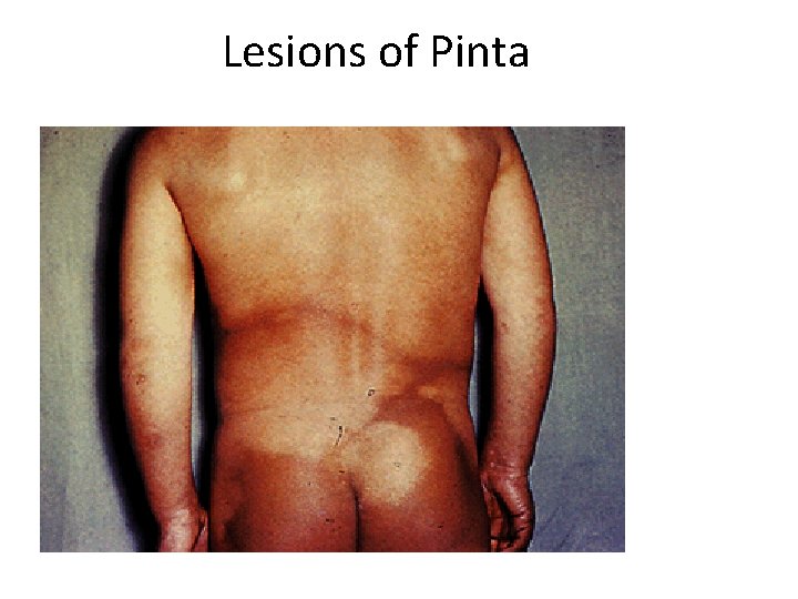 Lesions of Pinta 