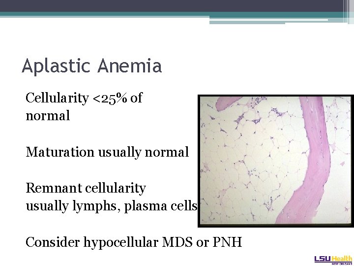 Aplastic Anemia Cellularity <25% of normal Maturation usually normal Remnant cellularity usually lymphs, plasma