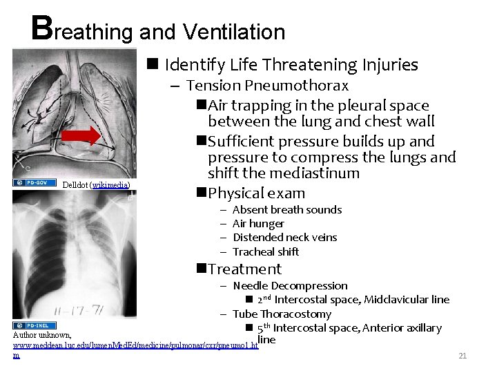 Breathing and Ventilation n Identify Life Threatening Injuries Delldot (wikimedia) – Tension Pneumothorax n.