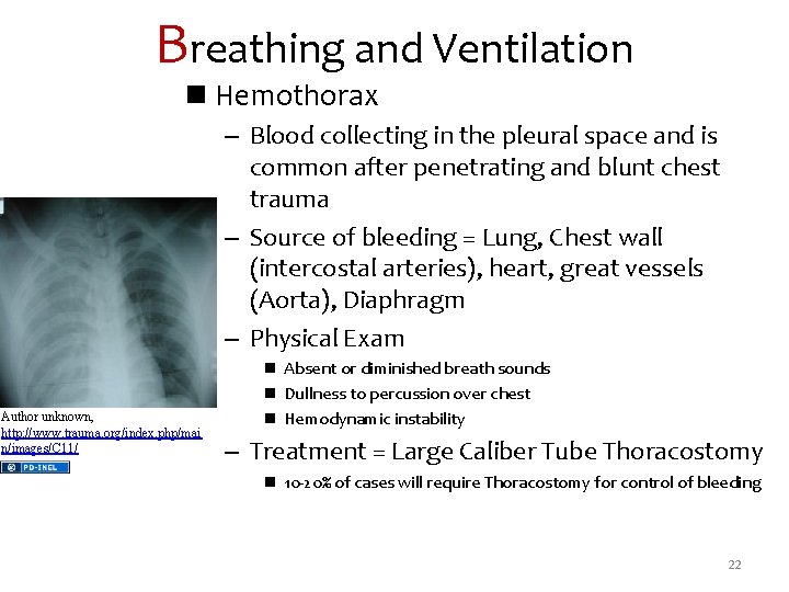 Breathing and Ventilation n Hemothorax – Blood collecting in the pleural space and is