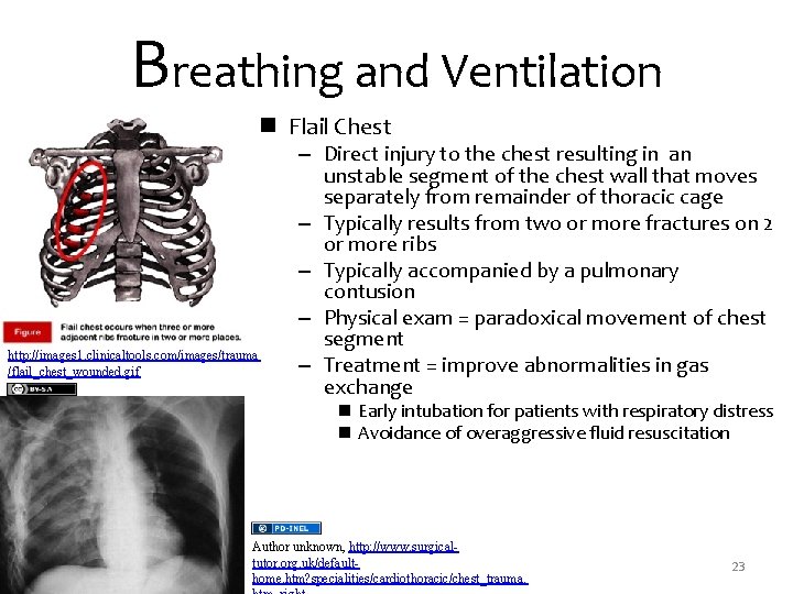 Breathing and Ventilation n Flail Chest http: //images 1. clinicaltools. com/images/trauma /flail_chest_wounded. gif –