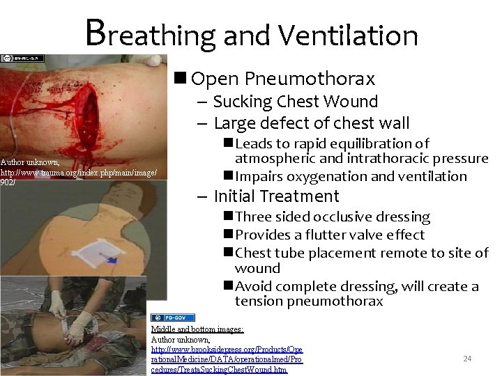 Breathing and Ventilation n Open Pneumothorax – Sucking Chest Wound – Large defect of