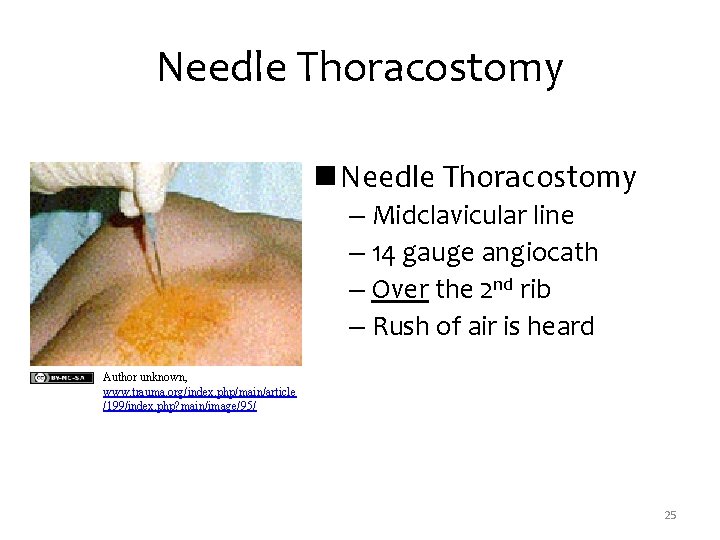 Needle Thoracostomy n Needle Thoracostomy – Midclavicular line – 14 gauge angiocath – Over