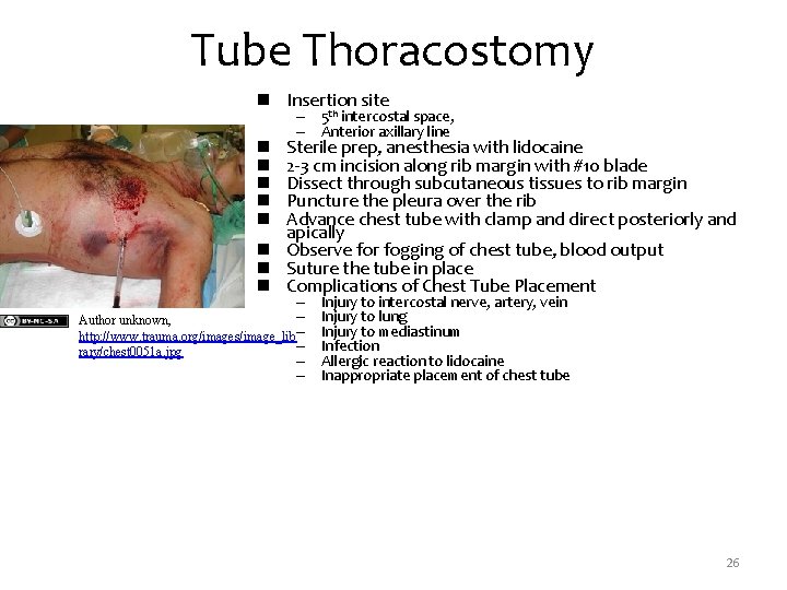 Tube Thoracostomy n Insertion site – 5 th intercostal space, – Anterior axillary line