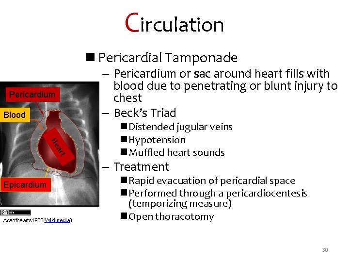 Circulation n Pericardial Tamponade Pericardium Blood – Pericardium or sac around heart fills with