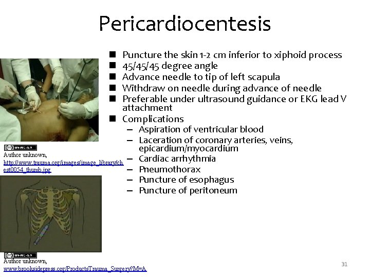 Pericardiocentesis Puncture the skin 1 -2 cm inferior to xiphoid process 45/45/45 degree angle