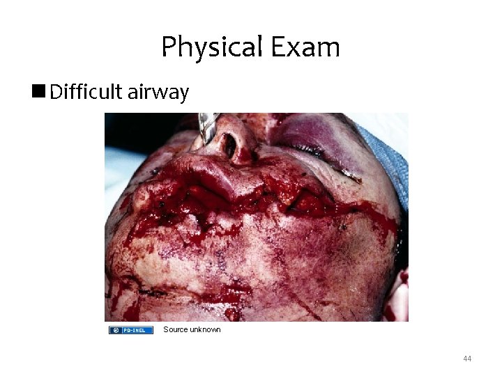 Physical Exam n Difficult airway Source unknown 44 