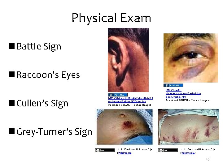 Physical Exam n Battle Sign n Raccoon's Eyes n Cullen’s Sign http: //sfghed. ucsf.