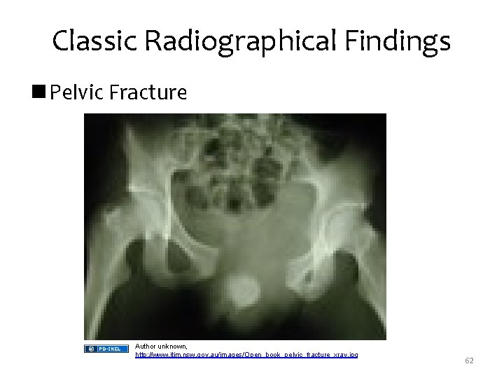 Classic Radiographical Findings n Pelvic Fracture Author unknown, http: //www. itim. nsw. gov. au/images/Open_book_pelvic_fracture_xray.