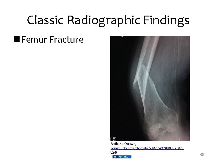 Classic Radiographic Findings n Femur Fracture Author unknown, www. flickr. com/photos/40939239@N 08/3771820 024/ 63
