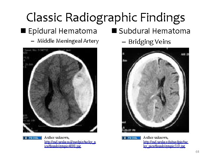 Classic Radiographic Findings n Epidural Hematoma – Middle Meningeal Artery Author unknown, http: //rad.