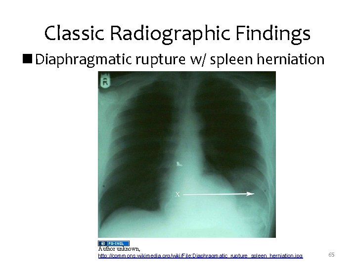 Classic Radiographic Findings n Diaphragmatic rupture w/ spleen herniation Author unknown, http: //commons. wikimedia.