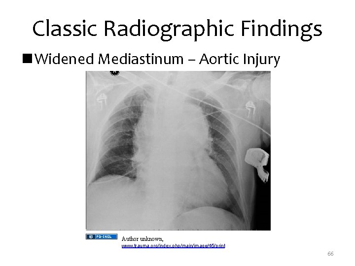 Classic Radiographic Findings n Widened Mediastinum – Aortic Injury Author unknown, www. trauma. org/index.