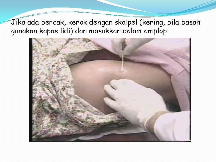 Jika ada bercak, kerok dengan skalpel (kering, bila basah gunakan kapas lidi) dan masukkan