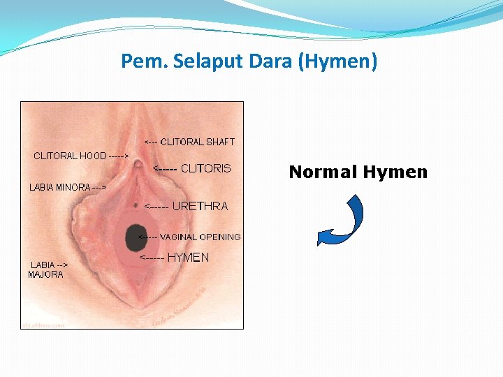 Pem. Selaput Dara (Hymen) Normal Hymen 