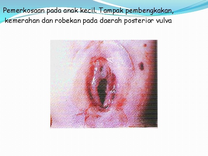 Pemerkosaan pada anak kecil. Tampak pembengkakan, kemerahan dan robekan pada daerah posterior vulva 