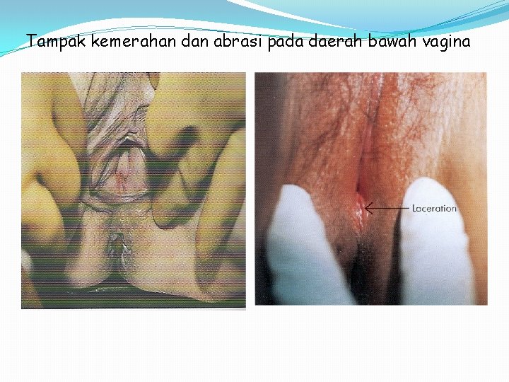 Tampak kemerahan dan abrasi pada daerah bawah vagina 