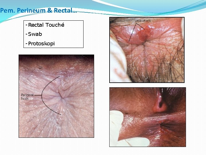 Pem. Perineum & Rectal… -Rectal Touché -Swab -Protoskopi 