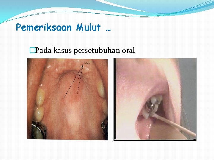 Pemeriksaan Mulut … �Pada kasus persetubuhan oral 