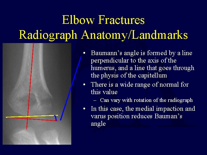 Elbow Fractures Radiograph Anatomy/Landmarks • Baumann’s angle is formed by a line perpendicular to