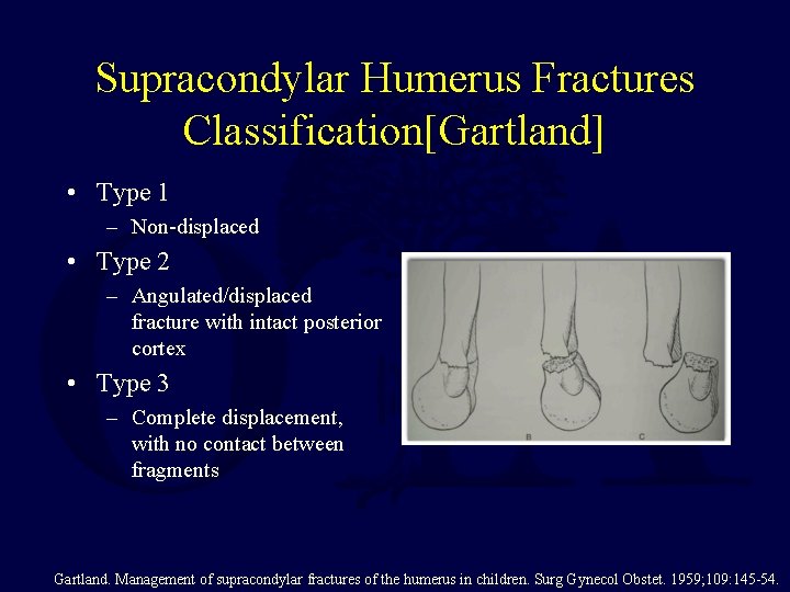 Supracondylar Humerus Fractures Classification[Gartland] • Type 1 – Non-displaced • Type 2 – Angulated/displaced